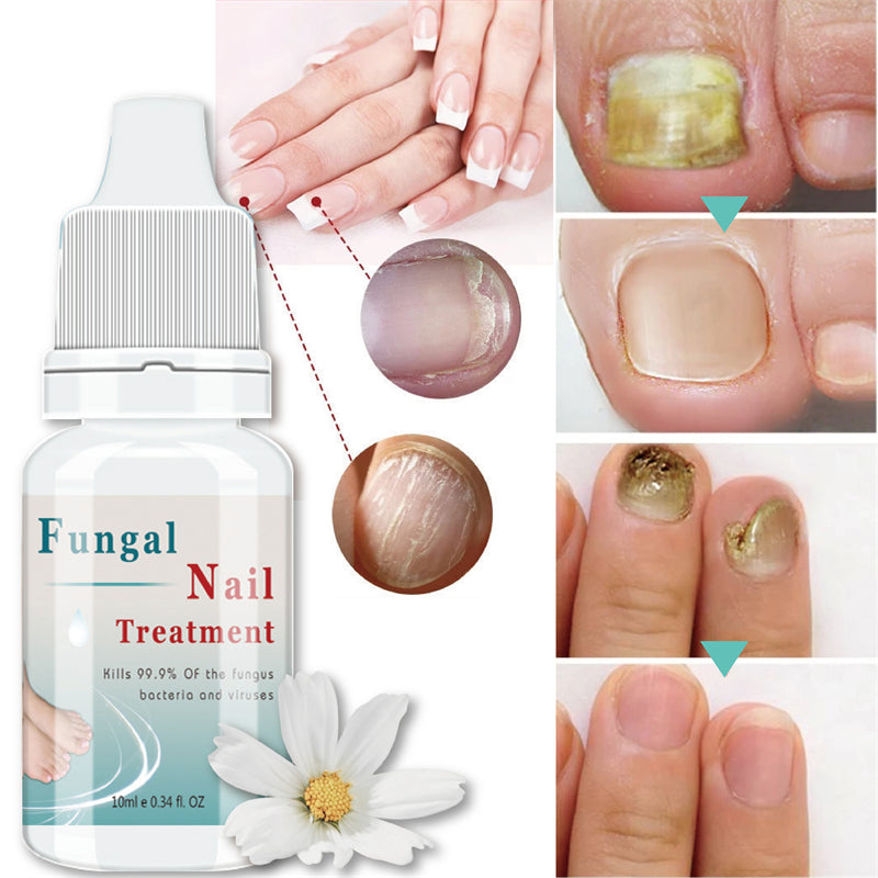 Nail Serum for Foot Care and Fungus Removal Gel